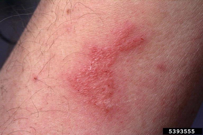 different bug bites that itch