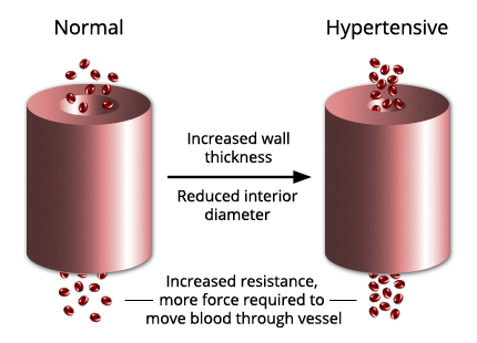 http://www.heartfailure.org/wp-content/uploads/2013/04/hypertension.jpg