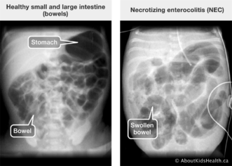 “In NEC, there is typically swelling of the bowels, gas in the bowel walls, and free air in the abdomen (belly).” 