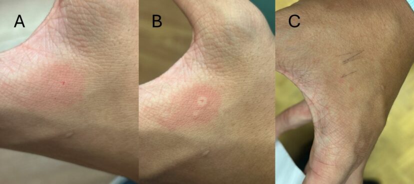 These three photos show an example of a reaction to a Jorō spider bite on the hand. Image A (to the far left) is immediately after the bite. Image B (in the middle) is five minutes afterward with visible swelling. Image C (to the far right) is twenty-four hours later, with faint red marks at the puncture sites. 