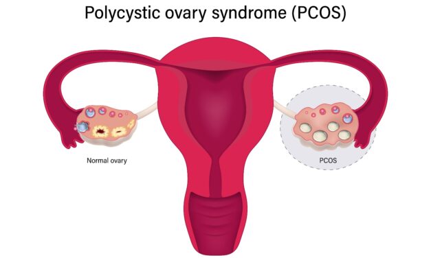Polycystic Ovarian Syndrome