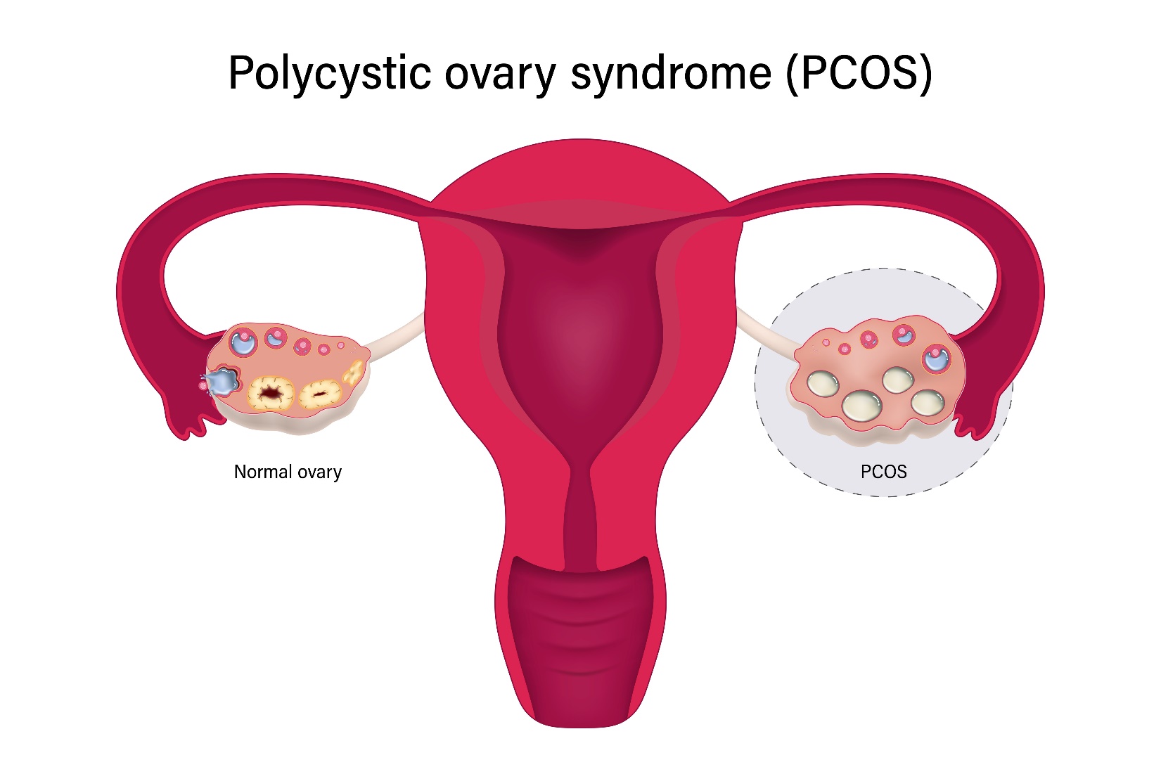 Polycystic Ovarian Syndrome   Home & Garden Information Center