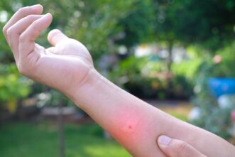 Insect sting.