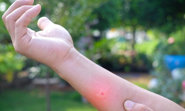 BITES BURNS BLOOD: First Aid for Skin Issues Resulting from Being Outdoors