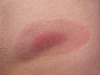 Lyme disease rash.