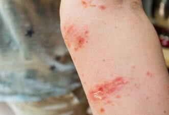 Poison Ivy rash.