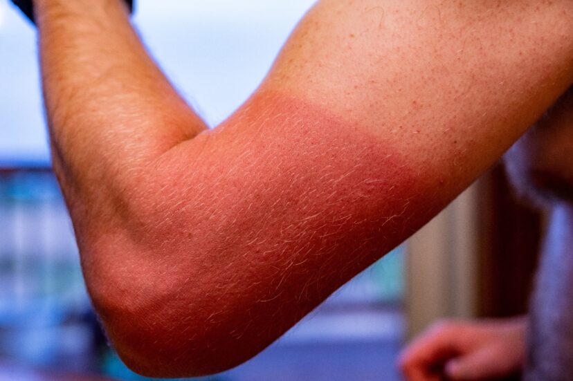 Sunburn.
